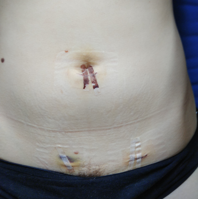 Closed laparoscopic appendectomy incision sites in middle aged woman four days after procedure.