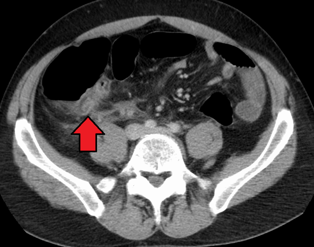 CT abdomen showing appendicitis.