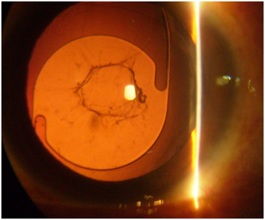 slit lamp photograph of monofocal posterior chamberintraocular lens taken in retroillumination. Yag laser capsulotomy opening is seen.
