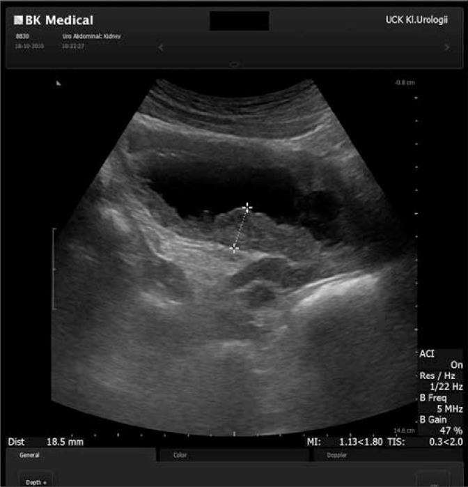 <p>Ultrasound of Bladder