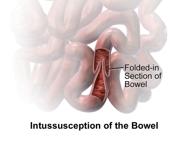 Diagram of intussusception of the bowel.