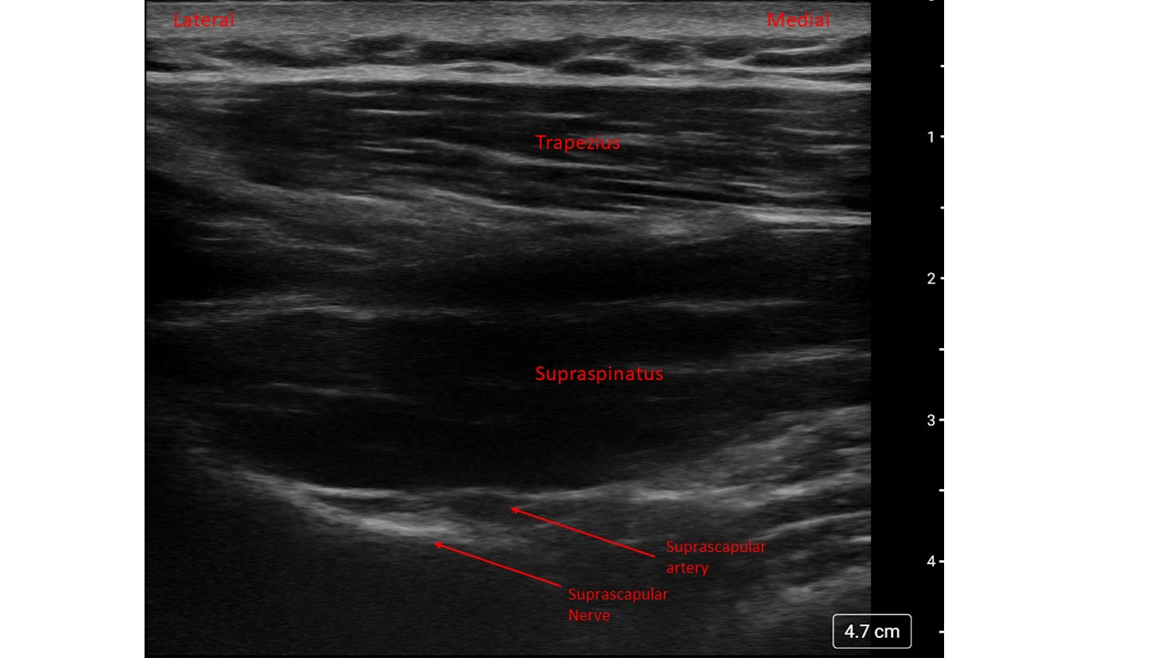 High frequency ultrasound view of the posterior approach to the suprascapular nerve.