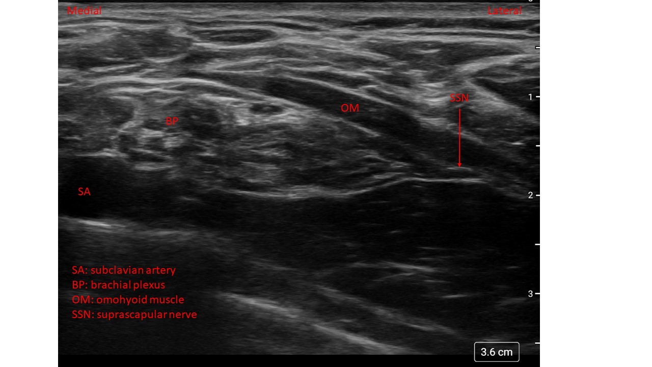 High frequency ultrasound view of the anterior approach to the suprascapular nerve.