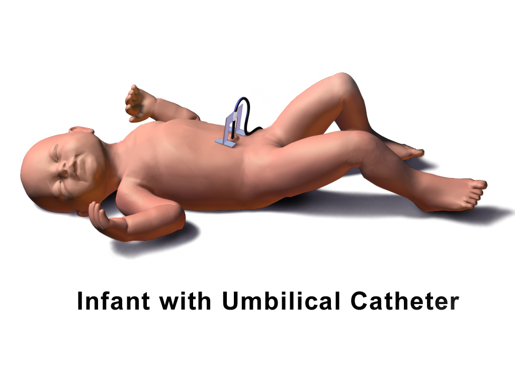 Diagram of an infant with an umbilical catheter.