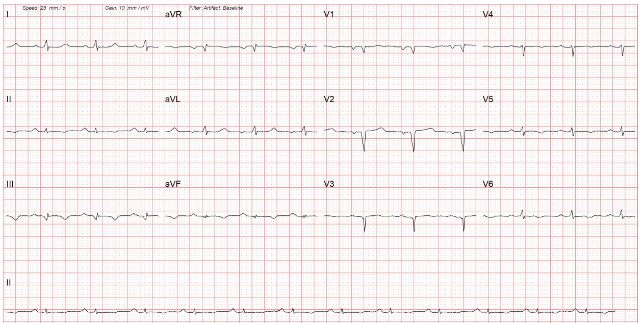 A 12-lead electrocardiogram of a patient with cardiac amyloidosis. There are low-voltage complexes in limb leads due to diffuse myocardial infiltration. The ECG also shows Q waves in the anterior chest leads due to myocardial fibrosis, giving a pseudoinfarction pattern. 