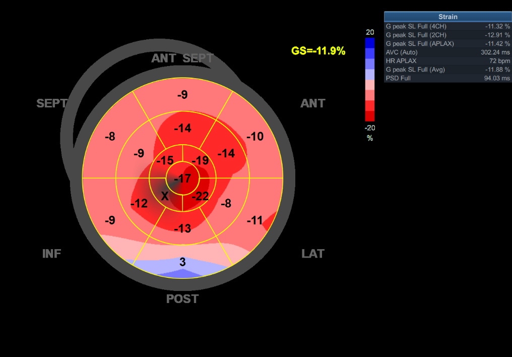 Figure 3 - The global longitudinal strain of a patient with cardiac amyloidosis, showing the typical 'cherry red spot' on a bull's eye map. The cherry-red spot implies a reduced base-mid strain, with relative sparing of LV apex. 