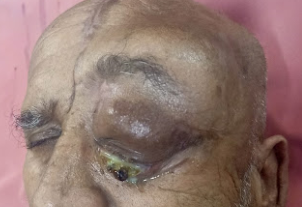 Left eye proptosis, periorbital edema and late echymosis due to orbital involvement of lymphoma
