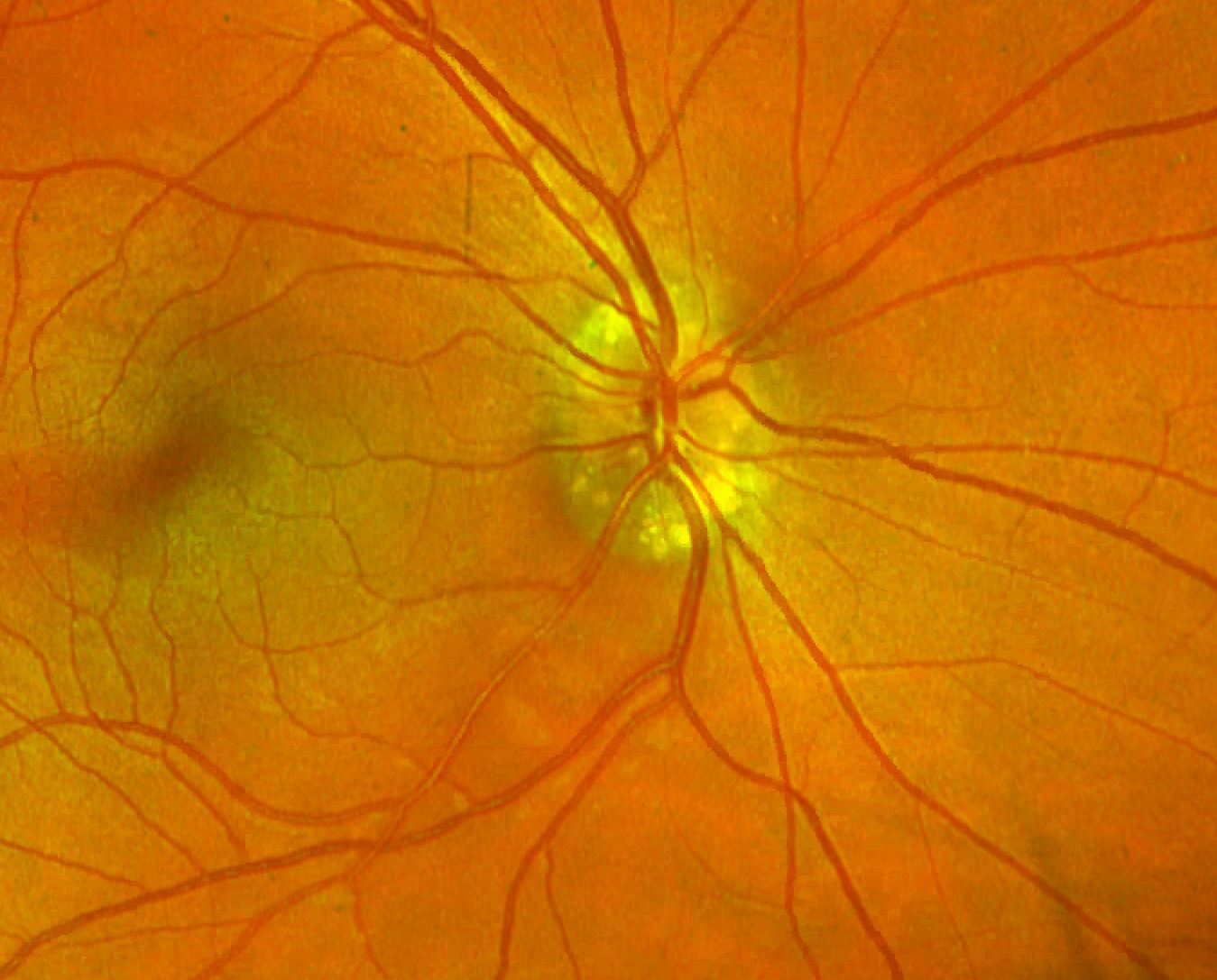 Fundus photo revealing pseudo papilledema from optic nerve head drusen