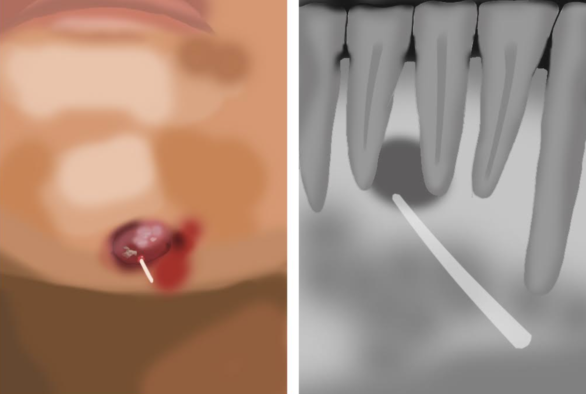 Example of an oral cutaneous fistula with associated x-ray.