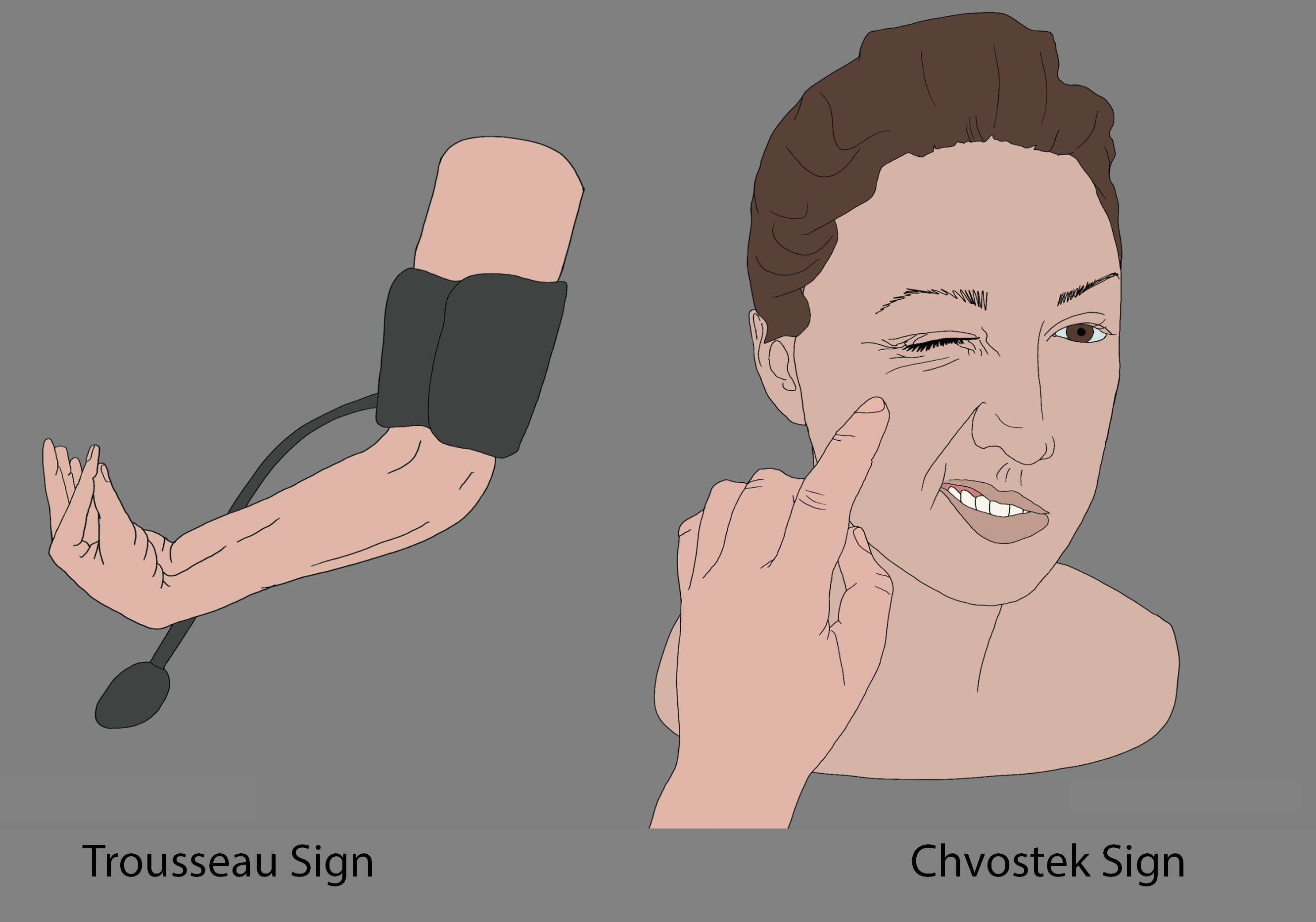 Diagram of finger tapping eliciting Chvostek and blood pressure cuff eliciting Trousseau sign.