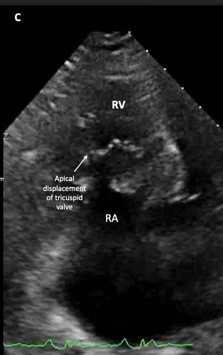 Apical displacement of tricuspid valve >8mm/m2 with enlarged right atrium, "atrialized" right ventricule and small "functional" right ventricle. 
