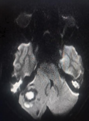 Light bulb sign in cerebellar abscess in DWI MR image