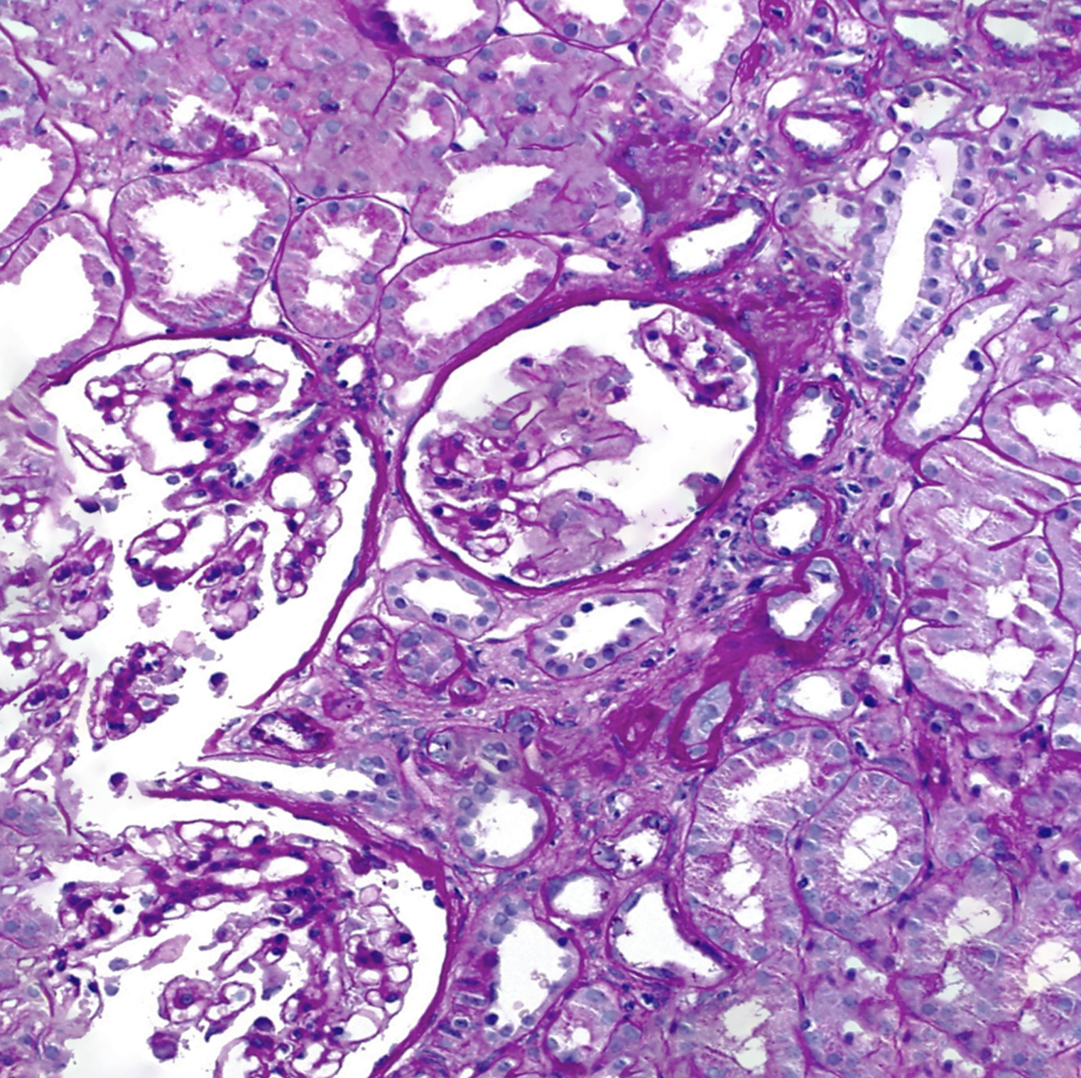 Kidney biopsy showing glomeruli in Alport syndrome.