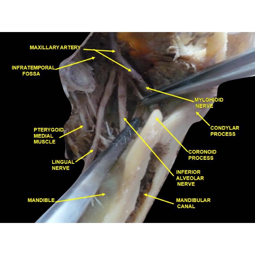 Anatomical dissection showing the lingual nerve.
