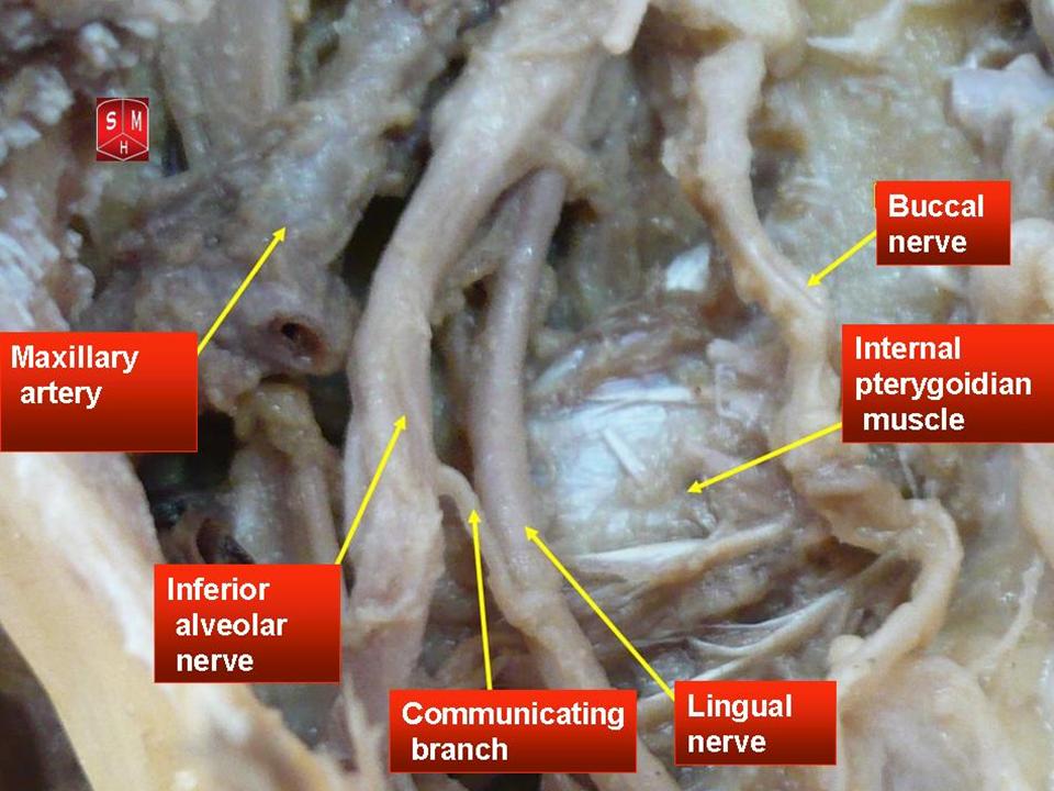 Dissection of the mandibular nerve.