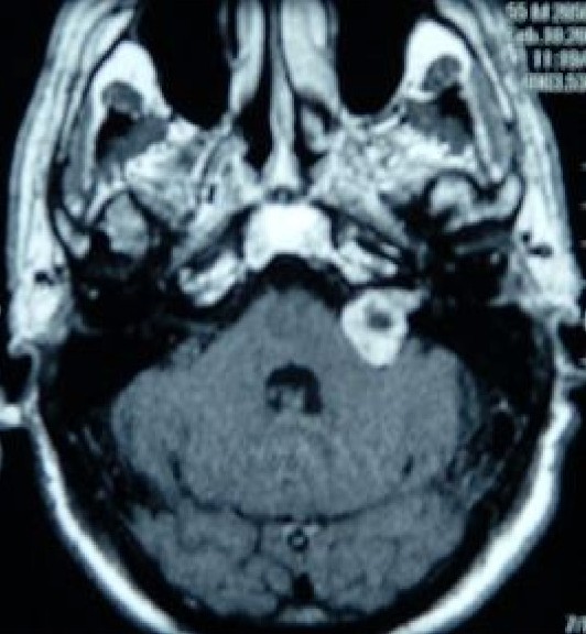 Axial MRI demonstrating left sided vestibular schwannoma