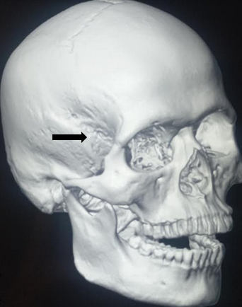 <p>Temporal Bone Location. This image shows the location of the temporal bone in the cranium.</p>