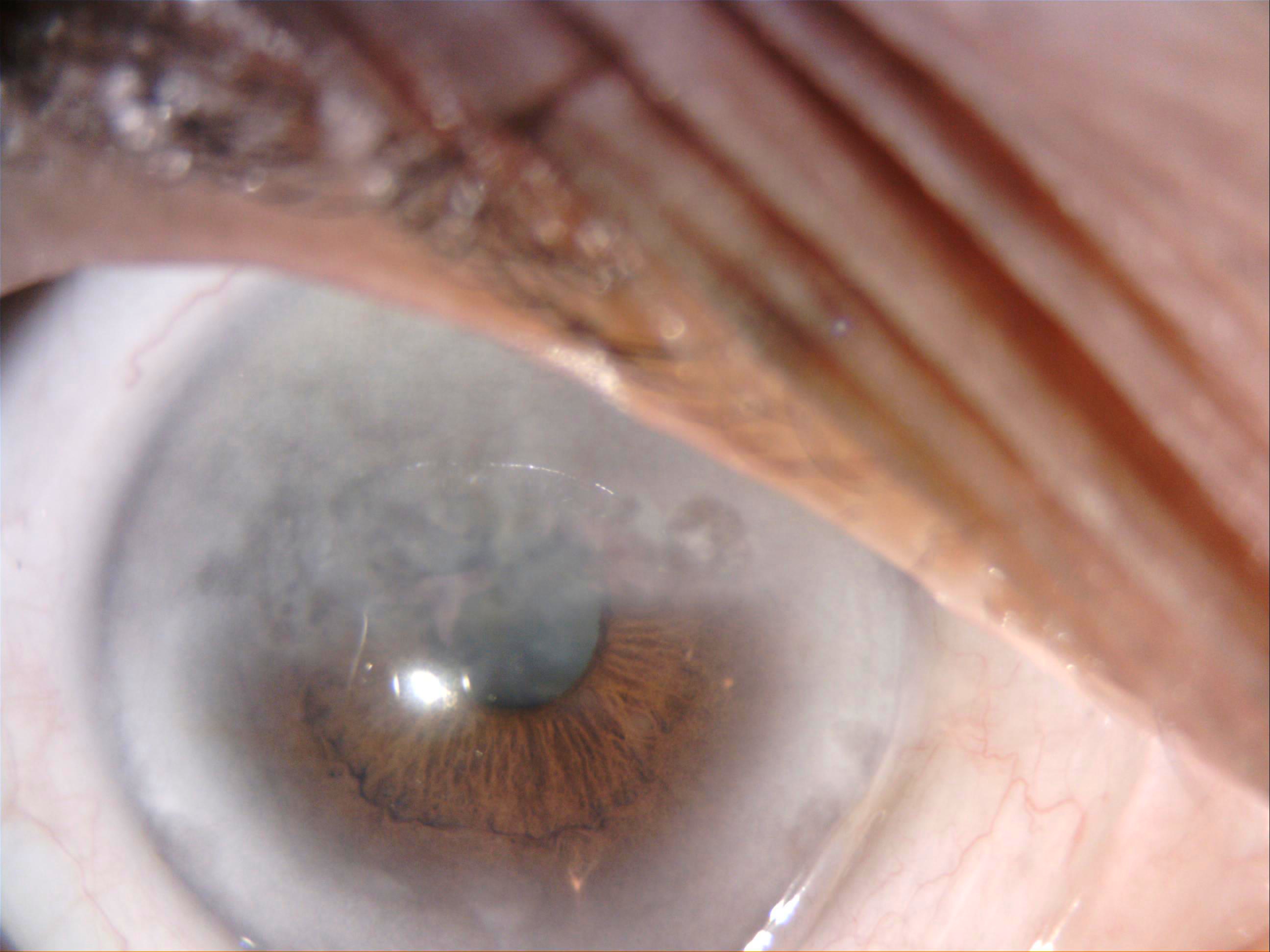 Slit-lamp image shows interstitial keratitis in a patient with hearing loss
