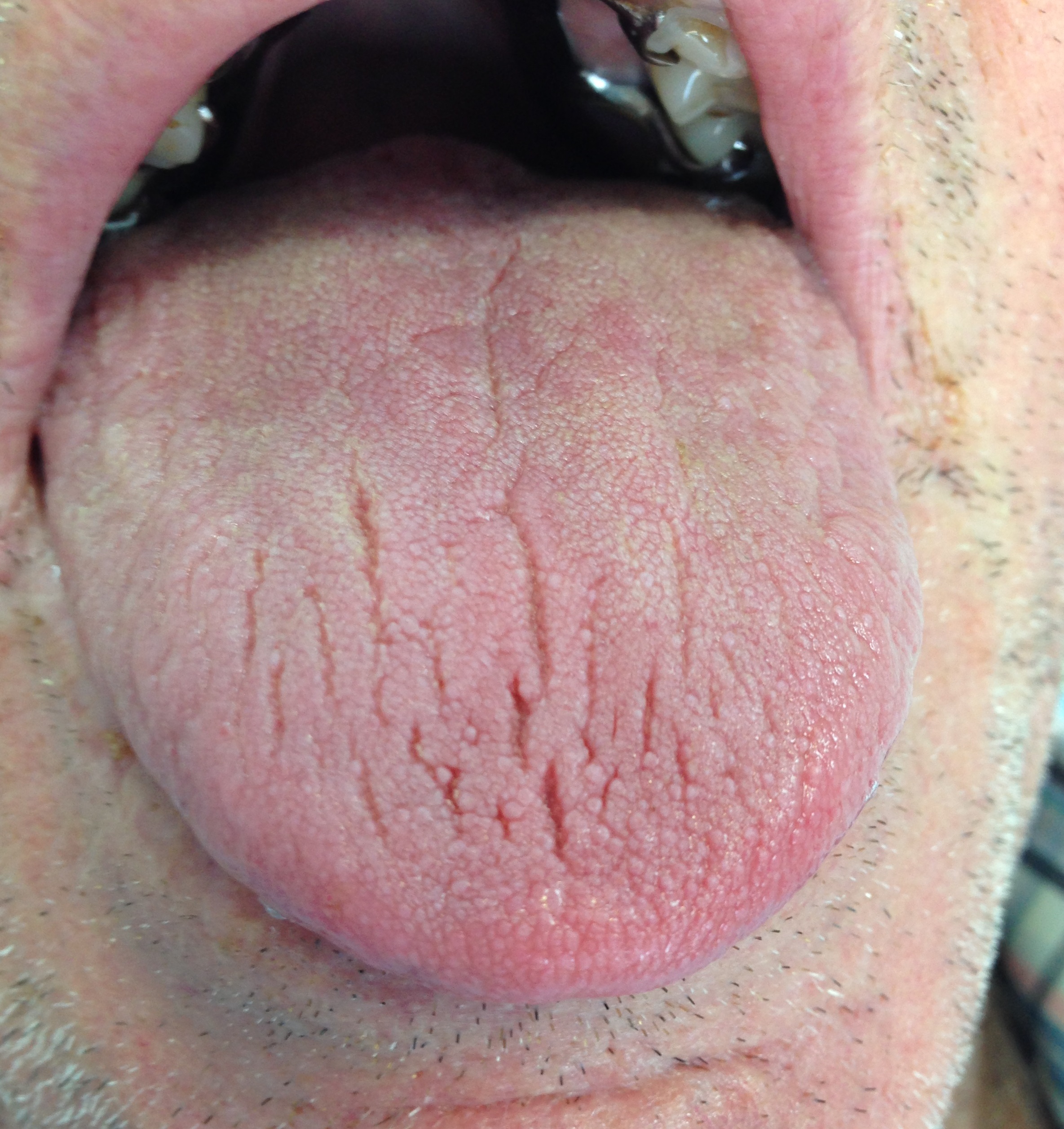 Patient with xerostomia (dry mouth). Note the fissures on the dorsum of the tongue.