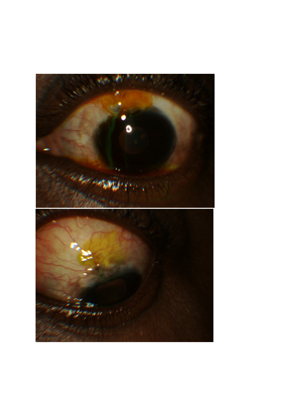 The Seidel test assesses for the occurrence of aqueous humor leakage through a defect in the integrity of the bleb. The image in the superior frame shows egress of aqueous from the anterior chamber through a thin fibrotic bleb occurring several years after trabeculectomy. This is made evident by the tracking of aqueous through the fluorescein stained ocular surface. In the lower frame, the image shows a cessation of aqueous leakage after revision of the bleb.  