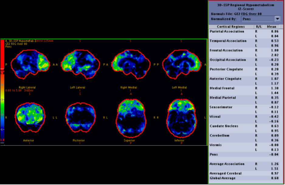 Figure 5. Frontotemporal Dementia. PET-CT images were obtained after intravenous injection of F-18 FDG. On the above image, there is significantly decreased F-18 FDG uptake identified within the bilateral frontal lobes. This is demonstrated as areas with green highlighting on the above image which represent areas with abnormal Z-scores. The Z-score refers to the number of standard deviations by which the patient’s mean F-18 uptake in a given region differs from that of age-matched reference population. In this exam, higher Z-scores are seen in areas with decreased metabolism; designation of hypometabolism as positive or negative Z score varies by convention among software packages. Given the abnormal Z-scores with the frontal cortices, findings are consistent with frontotemporal dementia.