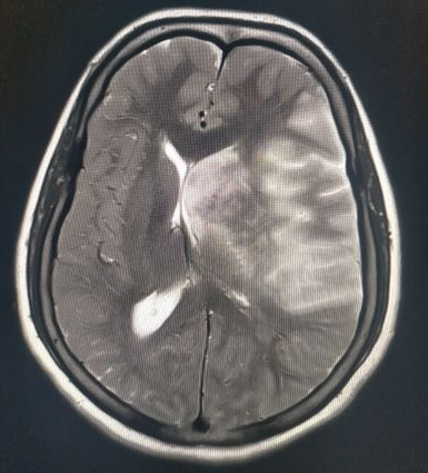 Subfalcine herniation in left MCA infarction where both distal anterior cerebral  arteries (DACA) are lying in vertical planes