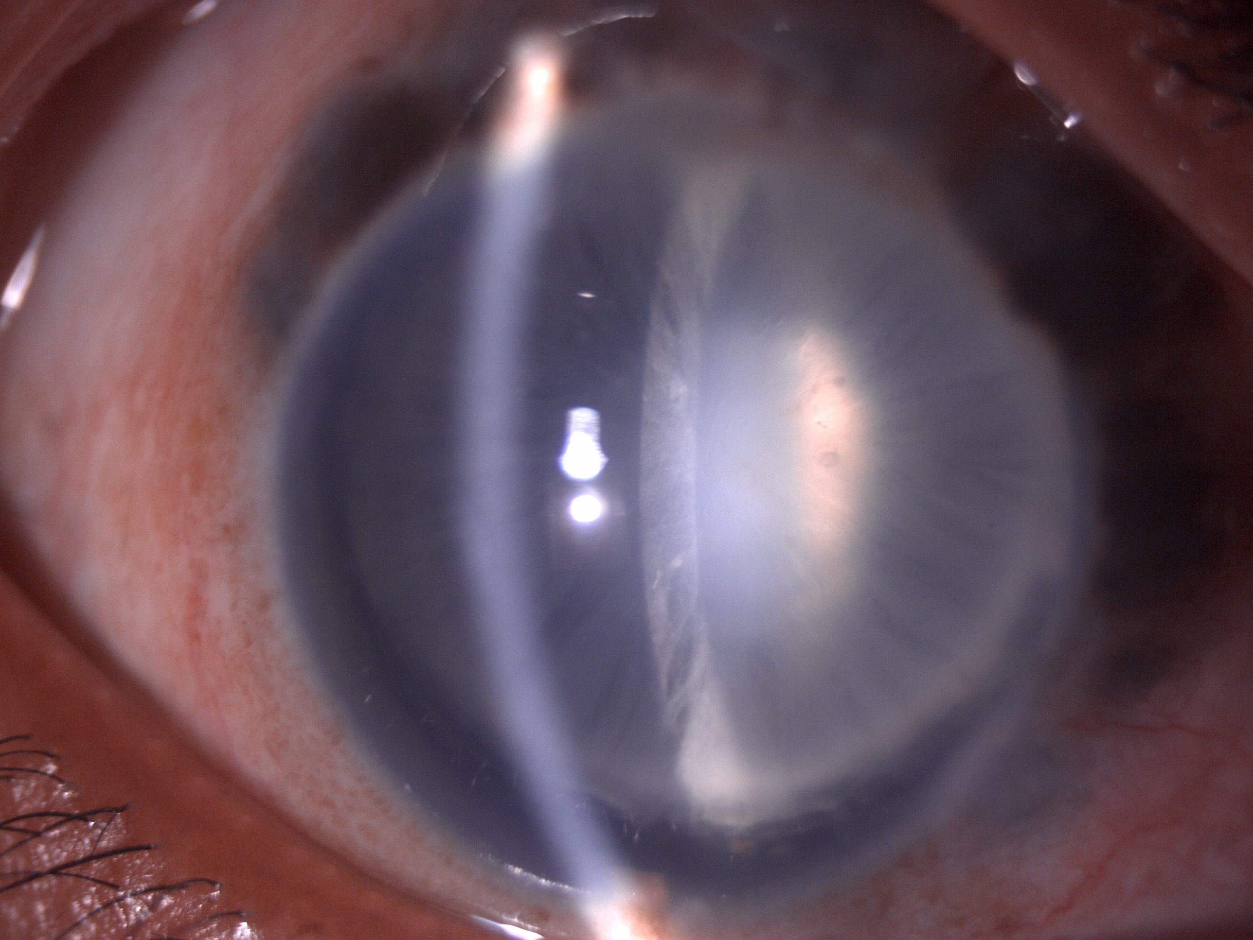 Digital image of the patient depicting mild congestion, scleral thinning, uveal show, deep anterior chamber, zonular dialysis and subluxated cataract who has been planned for MIGS