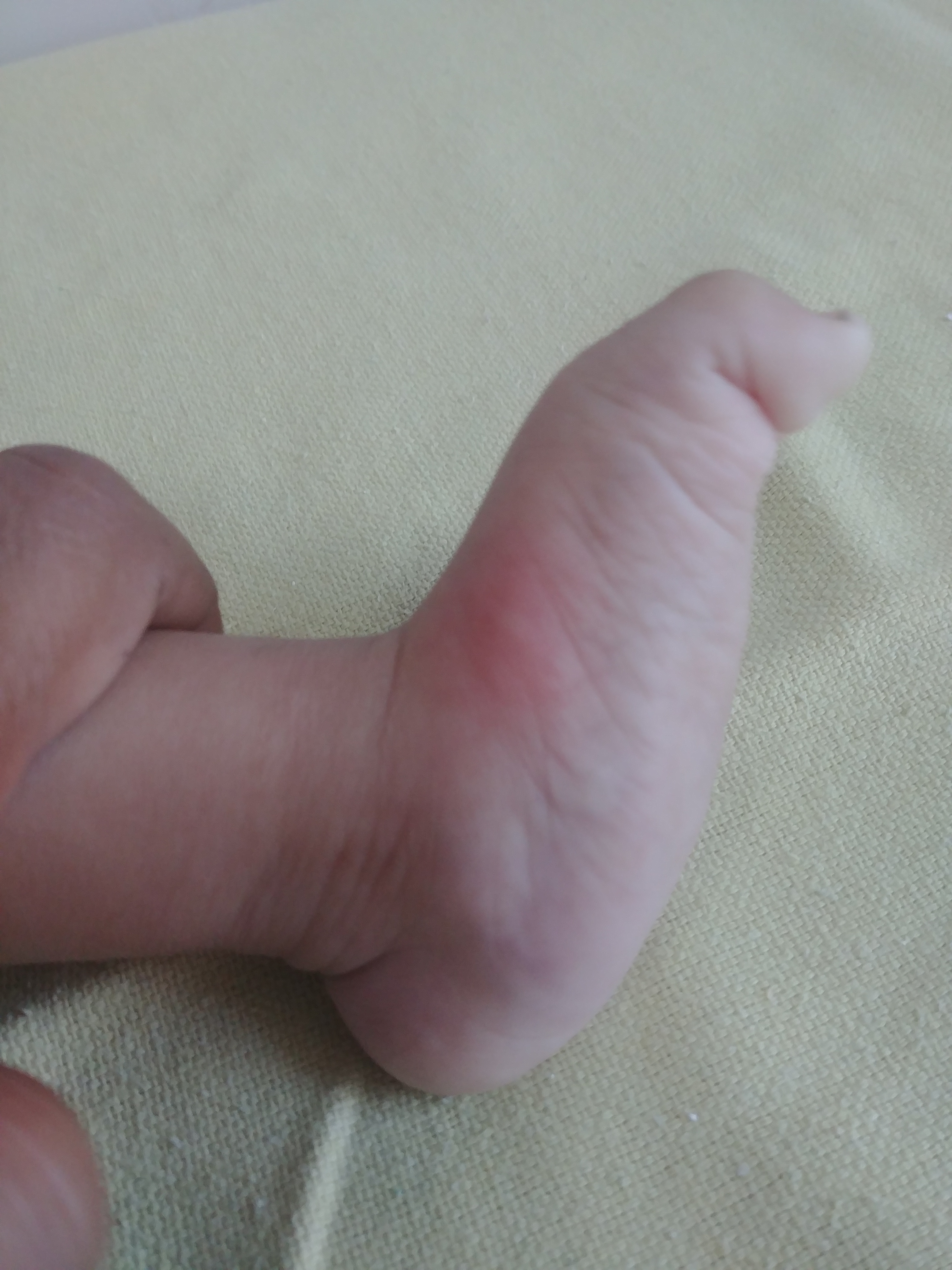 This clinical picture showing the rocket bottom appearance in a case of congenital vertical talus