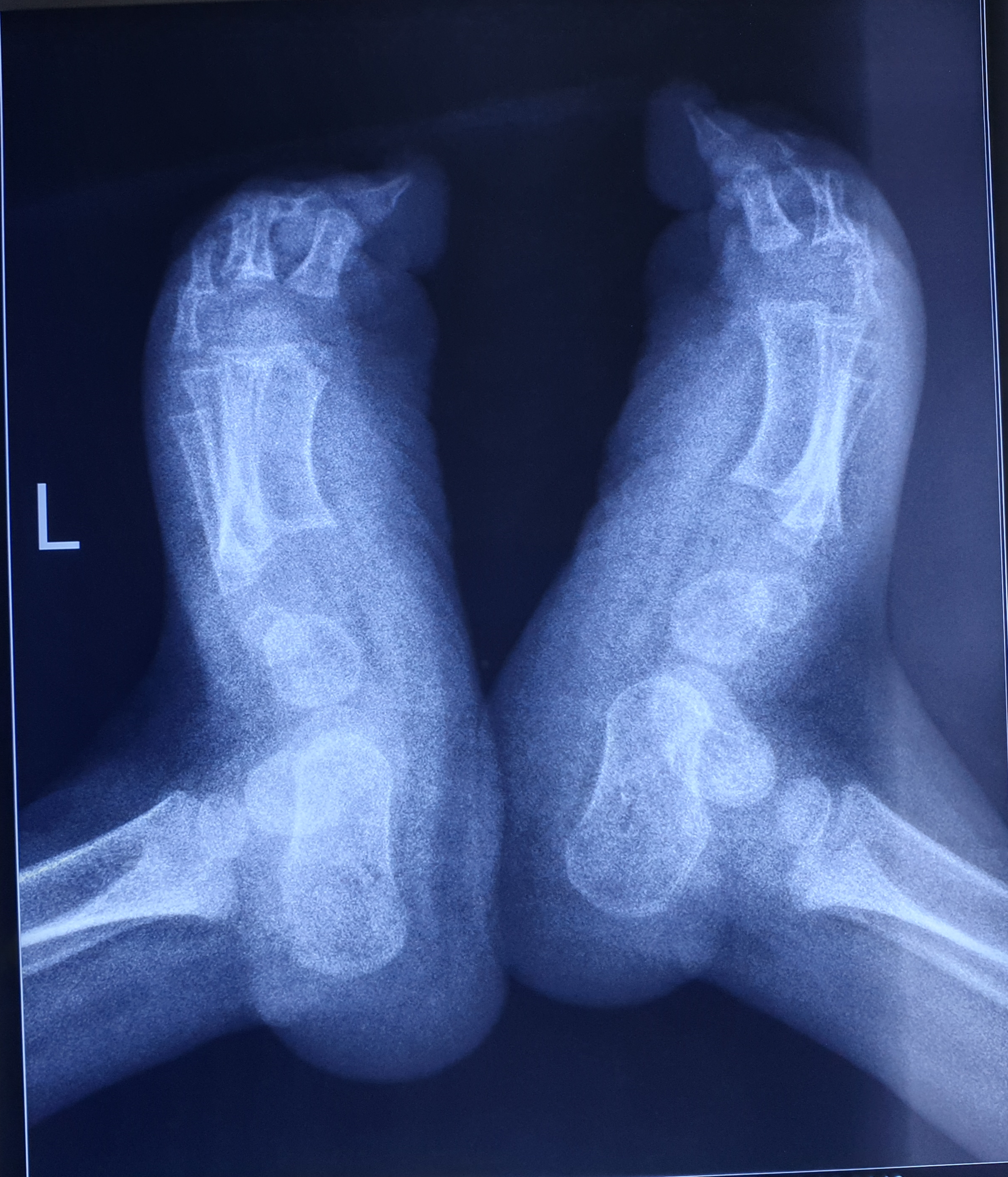 A radiograph of a child with congenital vertical talus
