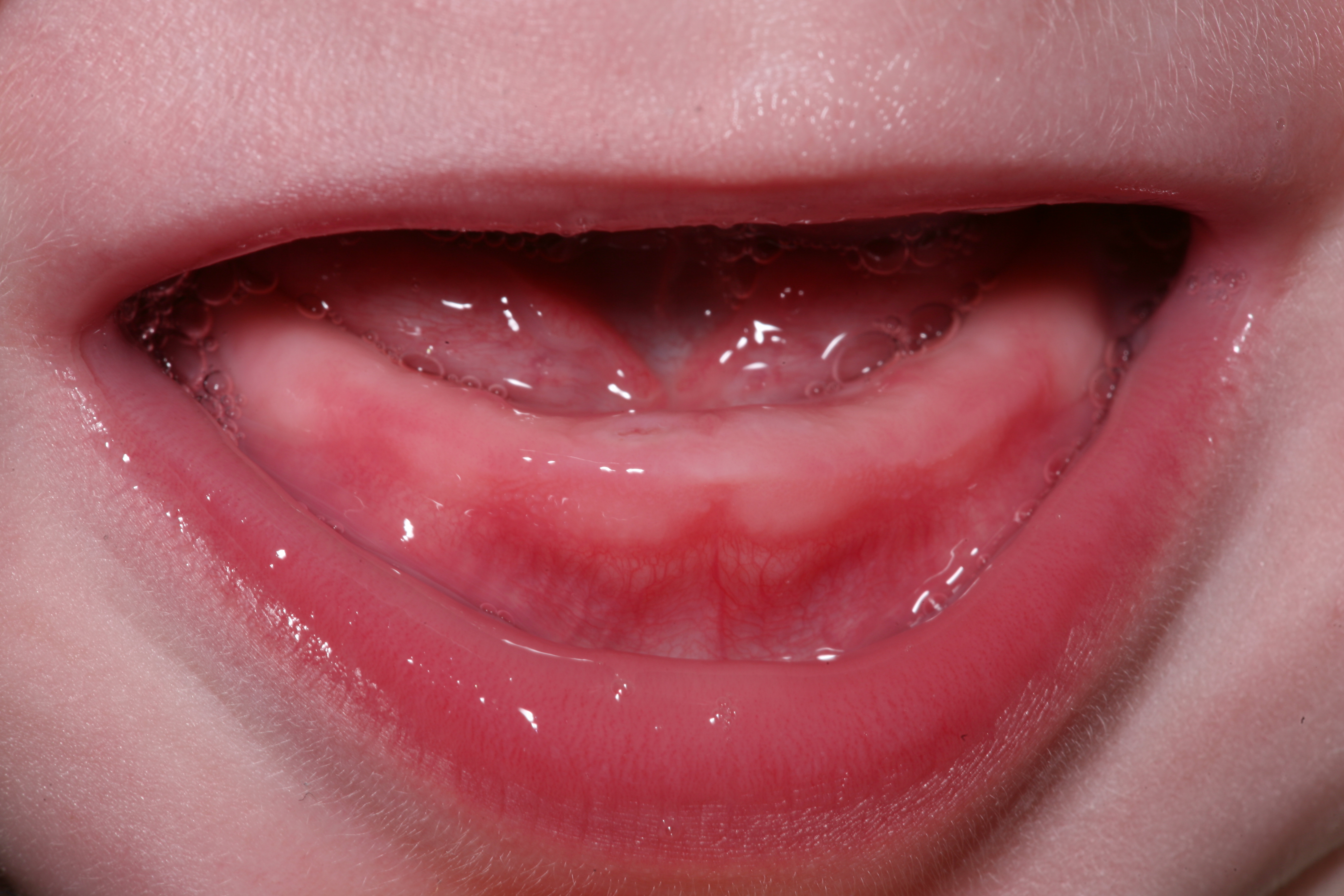 Teething baby: first sign of the lower right incisor breaking through the oral mucosa.