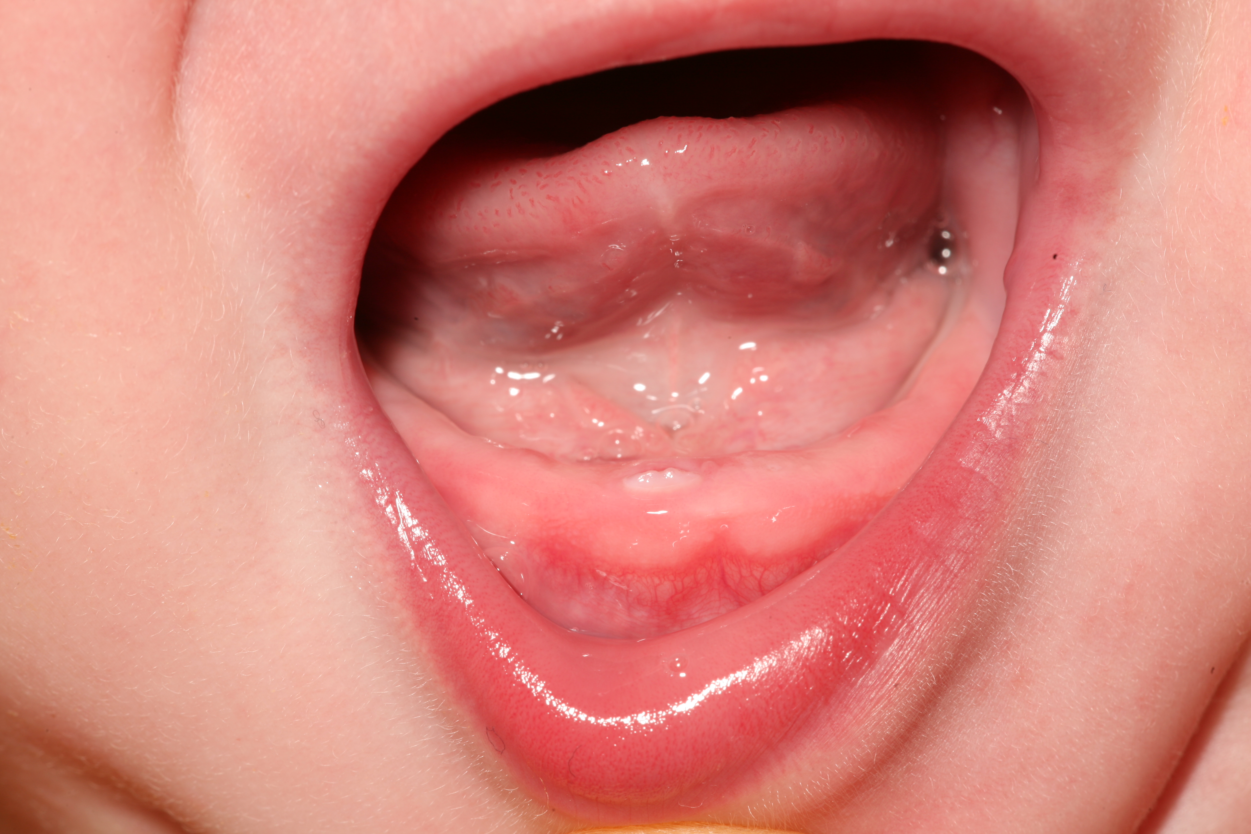 Teething baby: lower right incisor penetrating the oral mucosa.