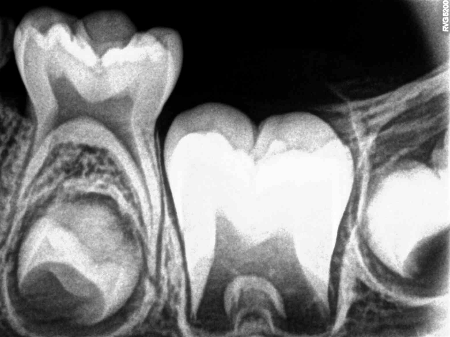 Intraoral Periapical Radiograph (IOPA) of a boy aged 5 years showing primary tooth #75 and developing crowns of permanent teeth 35, 36 and 37. Note the eruption path for 36 has been completed. The 36 is now in the post-emergence eruption stage.