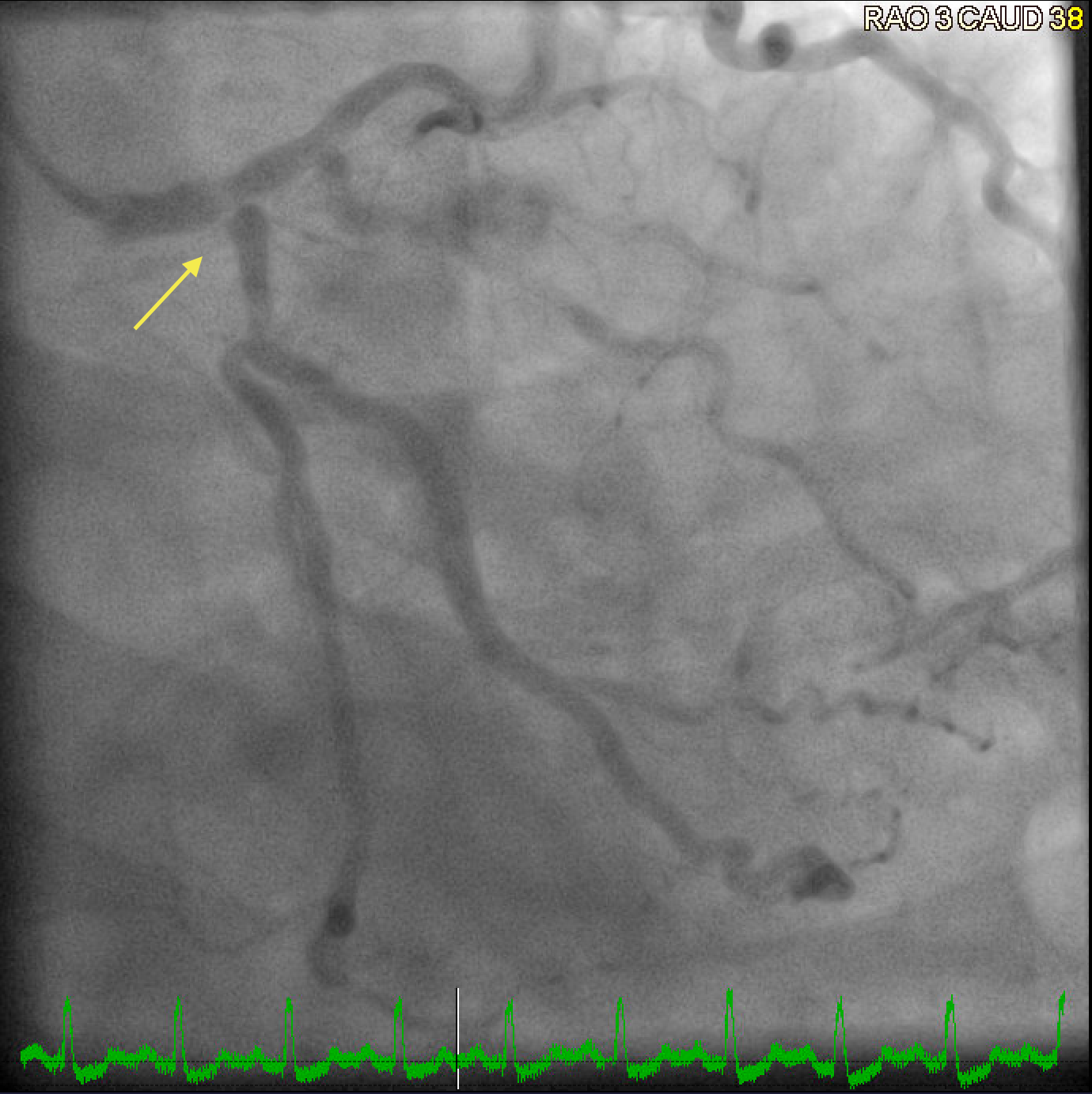 Coronary angiogram showing severe left main coronary artery disease with a bifurcation lesion involving the ostial left anterior descending artery and the ostial left circumflex artery.