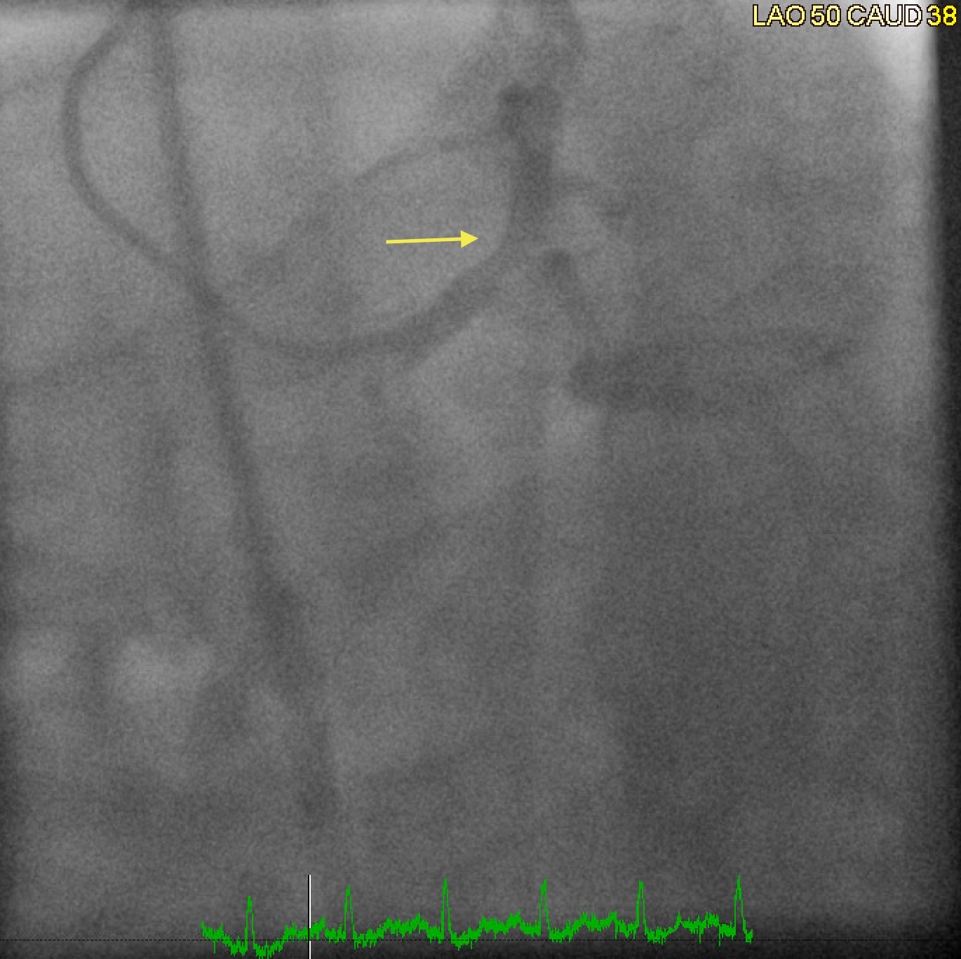 Coronary angiogram in a patient with radiation-induced coronary artery disease showing severe obstructive left main disease with bifurcation lesion affecting the Ostia of the left anterior descending artery and the left circumflex artery.