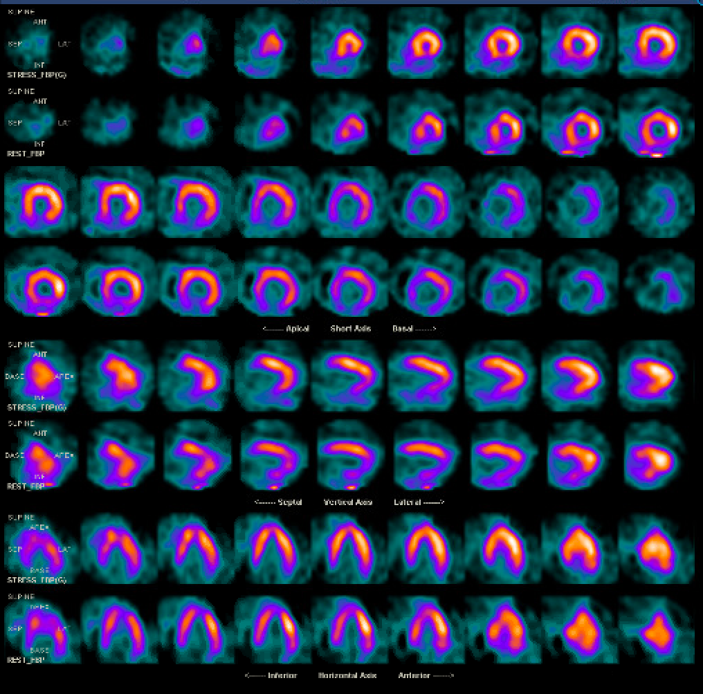 Single photon emission computed tomography (SPECT) myocardial perfusion imaging with adenosine showing fixed perfusion defect of the entire inferior wall in a patient with known mediastinal radiation exposure 15 years ago for Hodgkin's lymphoma. Lesion corresponds to ostial right coronary artery chronic total occlusion seen on coronary angiogram. (Rows 1,3,5,7 - stress images; Rows 2,4,6,8 - rest images)