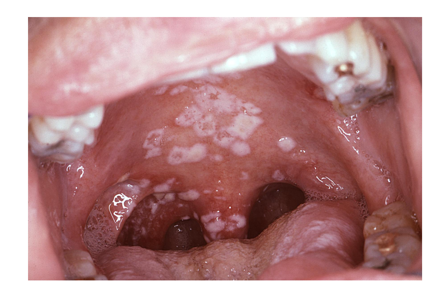 Oral pseudomembranous candidiasis infection.