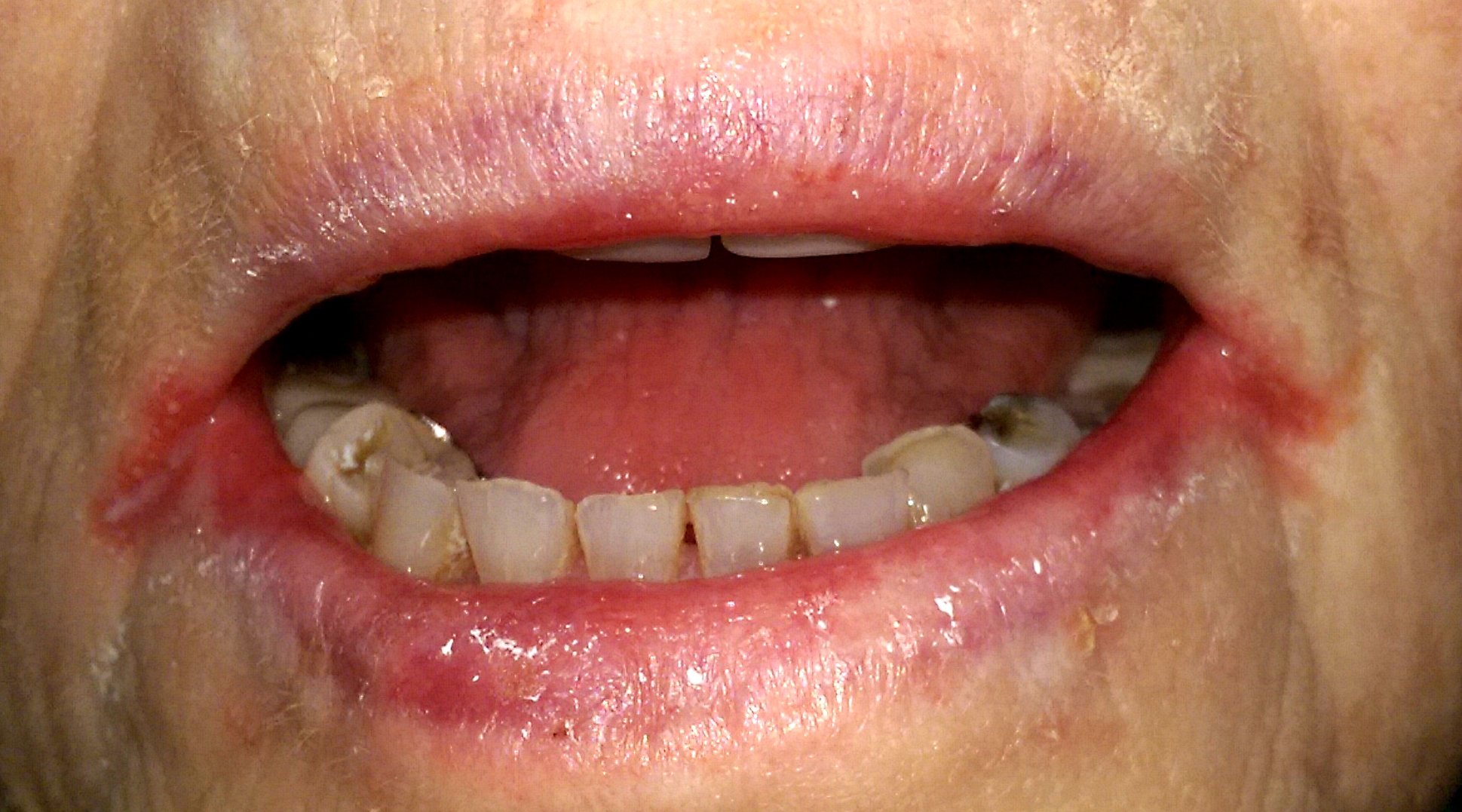 Angular cheilitis in elderly patient with false teeth, iron deficiency anemia and xerostomia. 