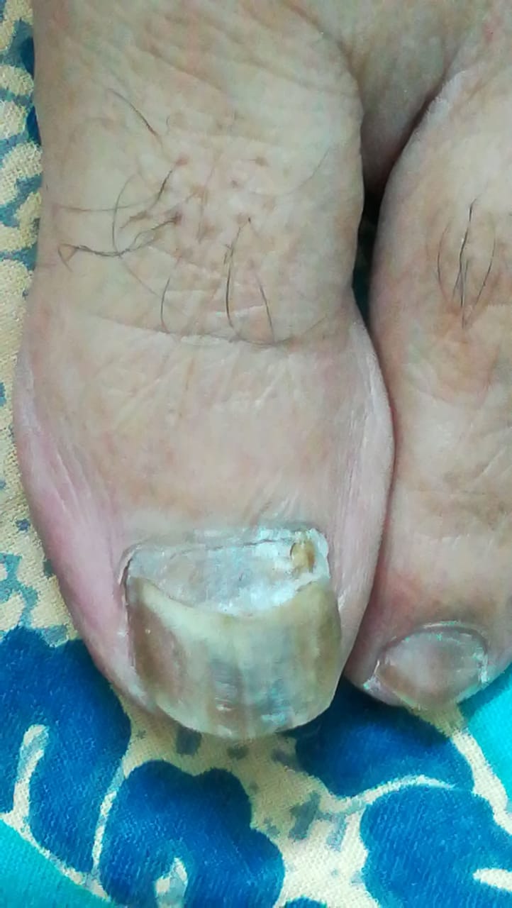 <p>Onychomycosis Nail Changes. Typical nail changes observed in a patient with onychomycosis.</p>