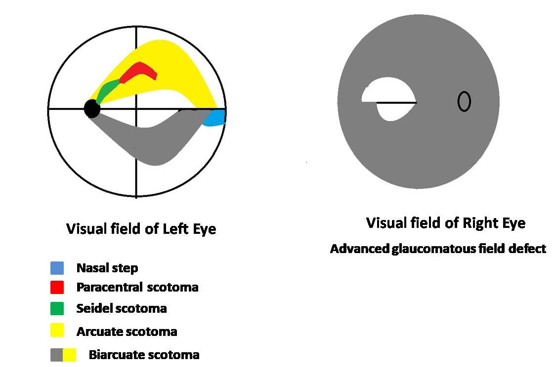 Types of field defect in glaucoma