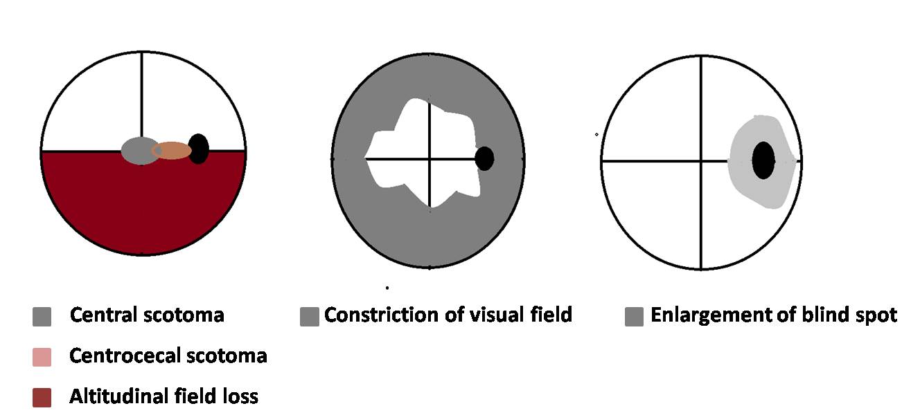 Types of visual field defect in other diseases