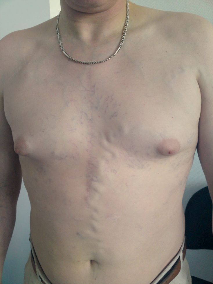 Superficial chest wall collateral venous engorgement secondary to superior vena cava obstruction