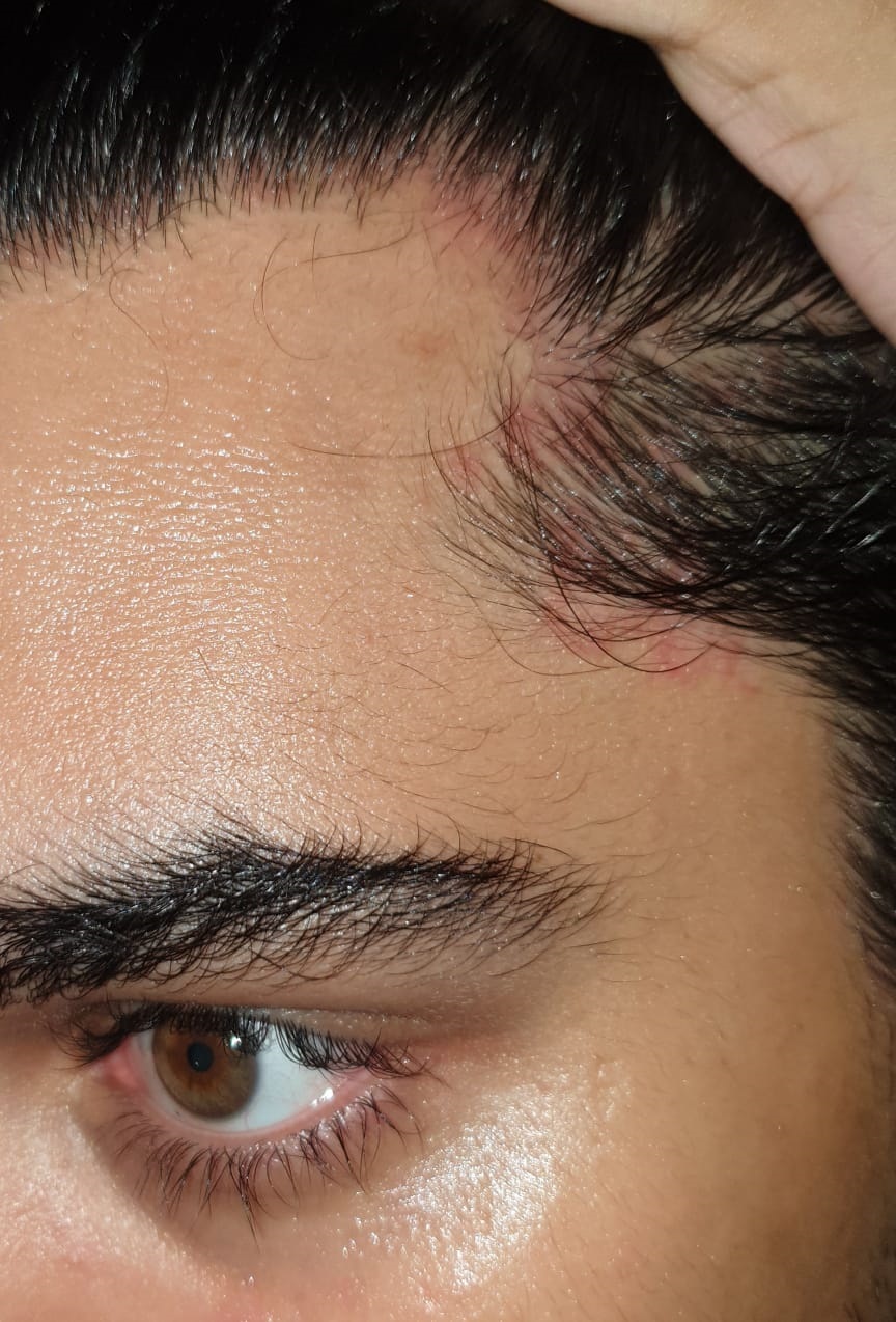 Seborrheic Dermatitis seen on the scalp extending to forehead.