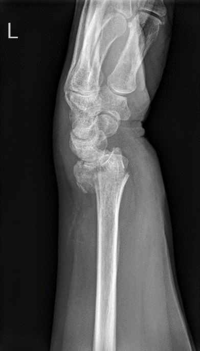 Lateral view Colle's Fracture ( Dorsal angulation and comminution)