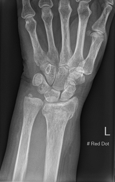 AP view of a typical Colle's fracture ( Extra-articular distal radius with radial shortening and loss of radial inclination). Associated with ulnar styloid fracture.