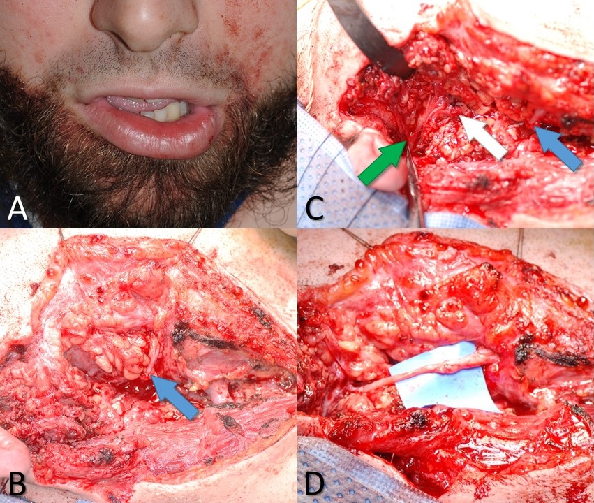A 26-year-old male with a knife wound to the right neck. A) Weakness of the right depressor labii inferioris muscle indicates likely injury to the marginal mandibular branch of the facial nerve. B) Blue arrow indicates the distal stump of the marginal mandibular nerve, as seen during neck exploration. C) White arrow indicates the proximal stump of the marginal mandibular nerve and the green arrow indicates the pes anserinus of the facial nerve. D) Proximal and distal stumps of the marginal mandibular nerve coapted microsurgically using 10-0 nylon suture and an interposition graft taken from the ipsilateral greater auricular nerve.