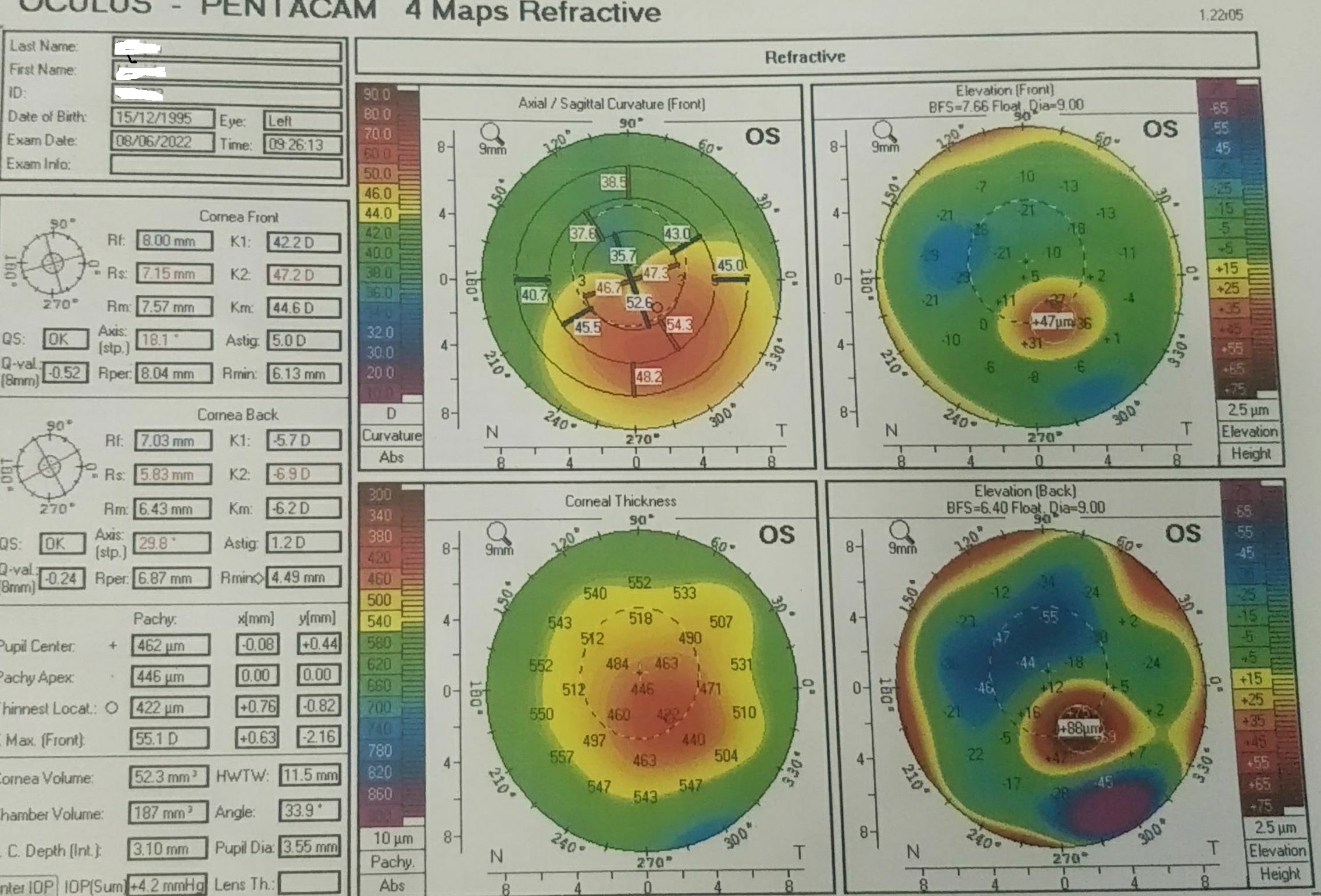 Two years post collagen crosslinking Pentacam  topogtraphy (4 map refractive) of a 25 year old male .