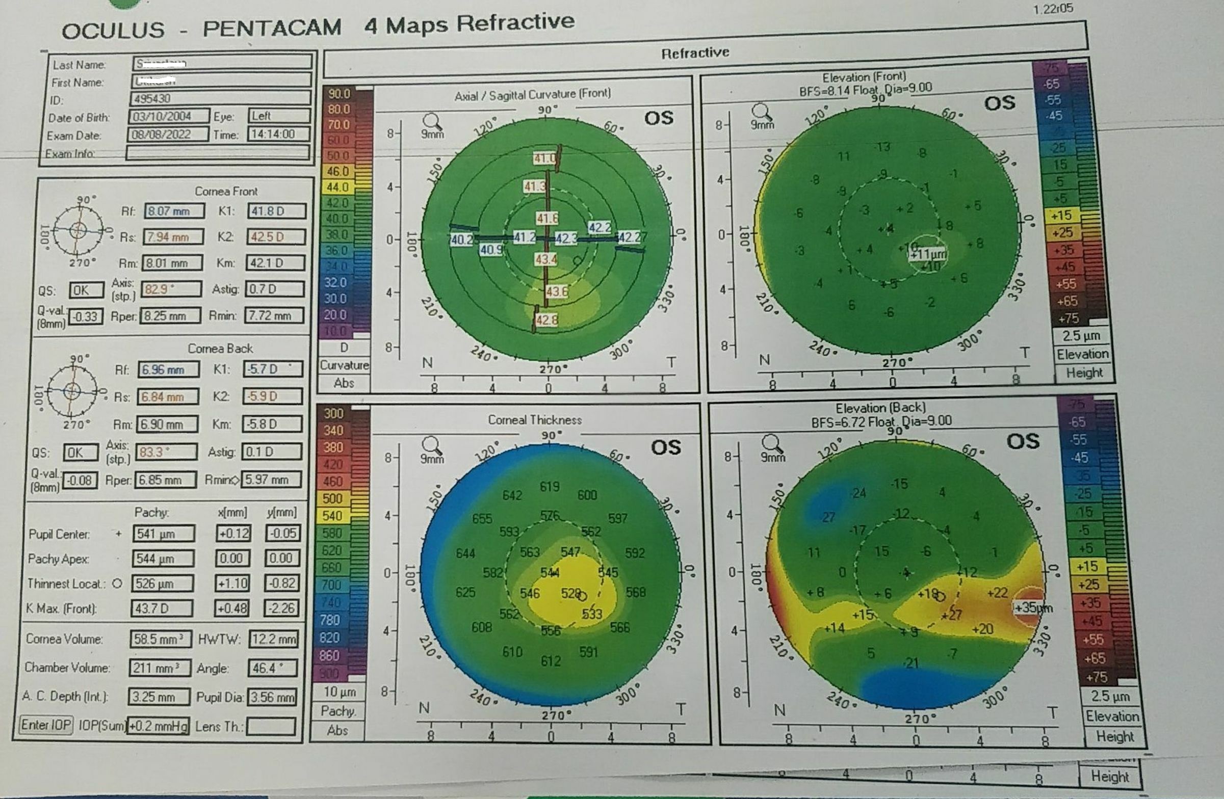Pentacam 4 map refractive of the left eye of an 18 year old  male . The right eye has advanced keratoconus