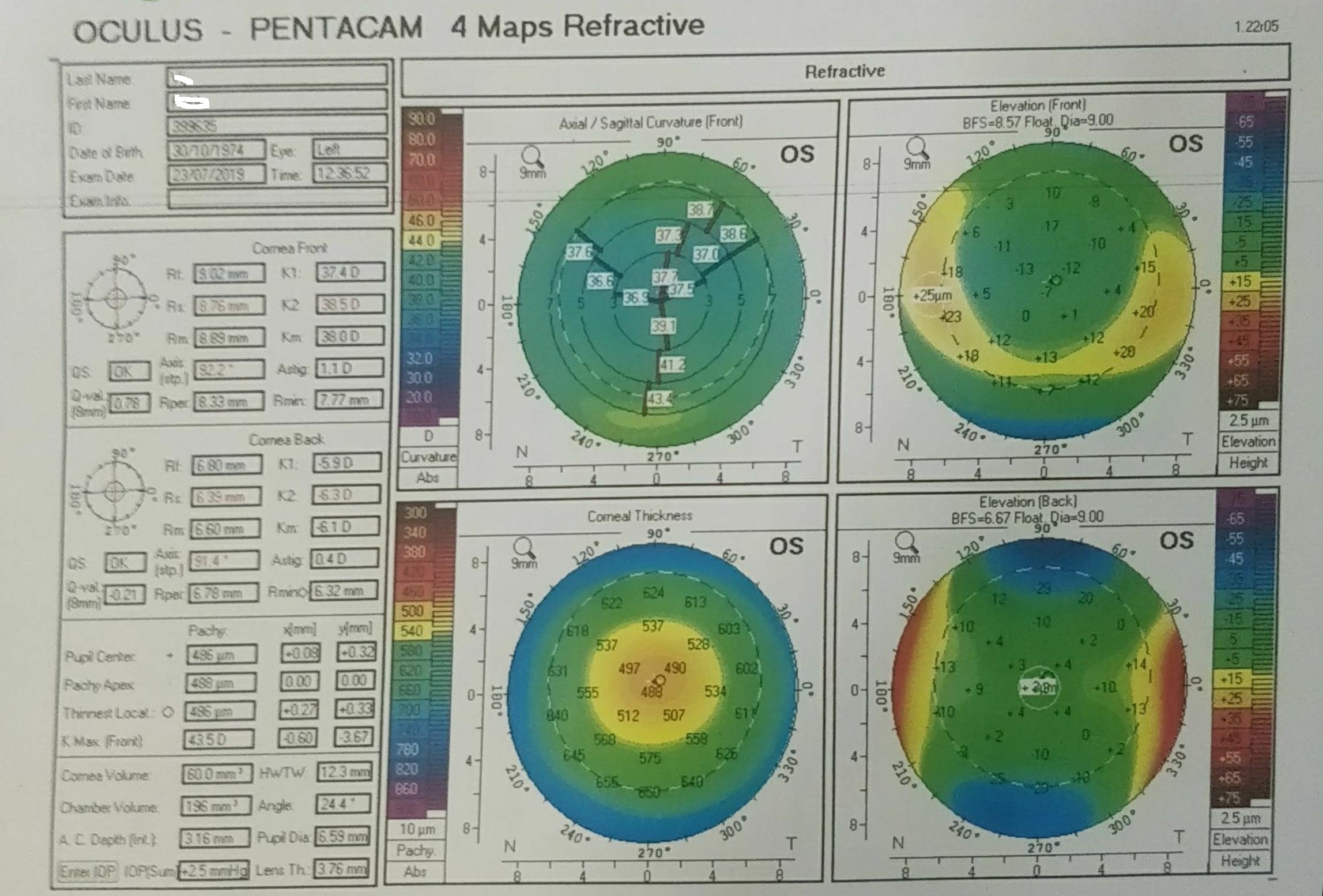 Pentacam 4 map refractive of left eye  a 45 year old male , 20 years after LASIK surgery.