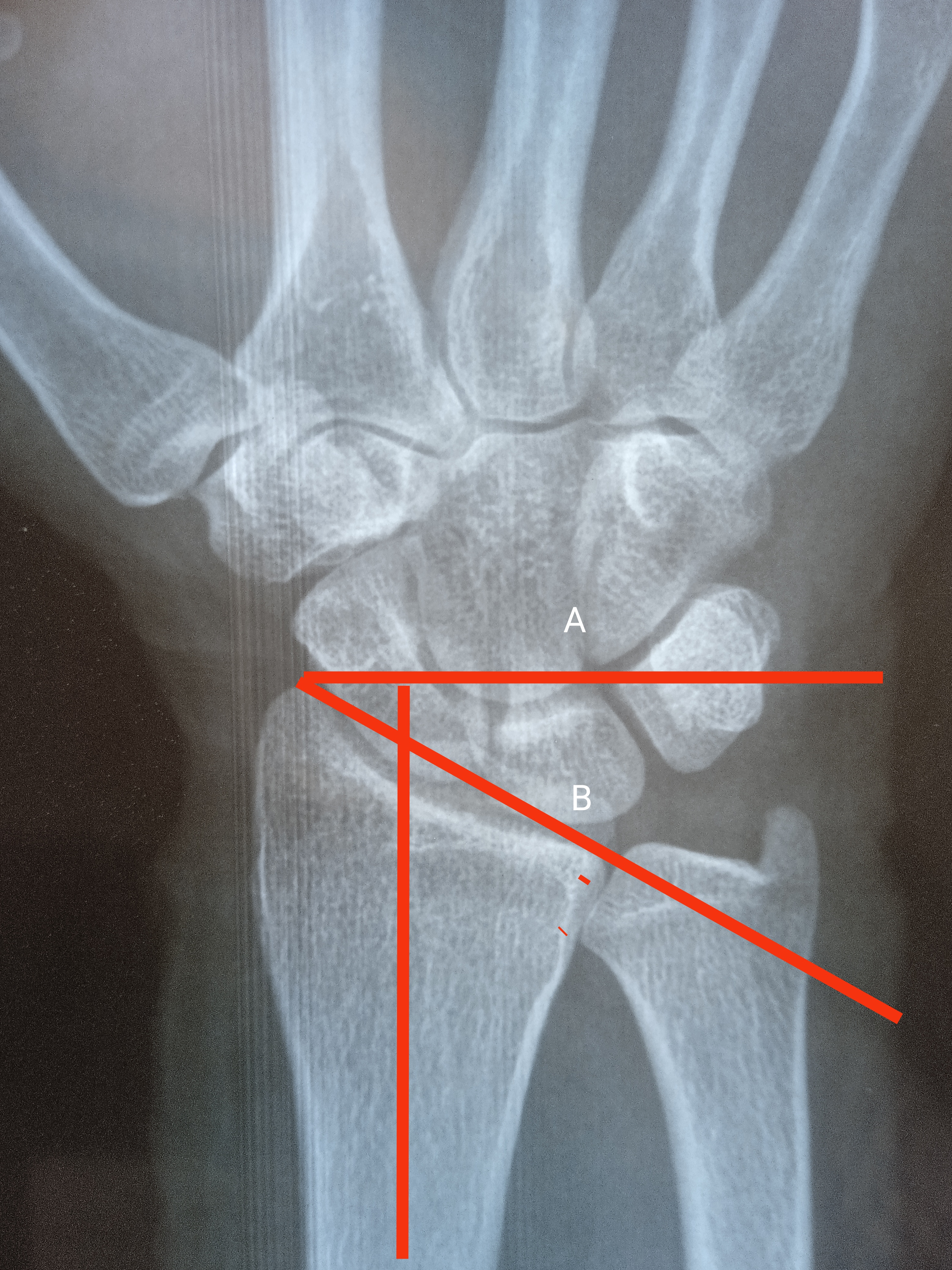 Radial Inclination Angle:
Line A is perpendicular to long axis of radius while line B connects radial and ulnar articular surface of distal radius