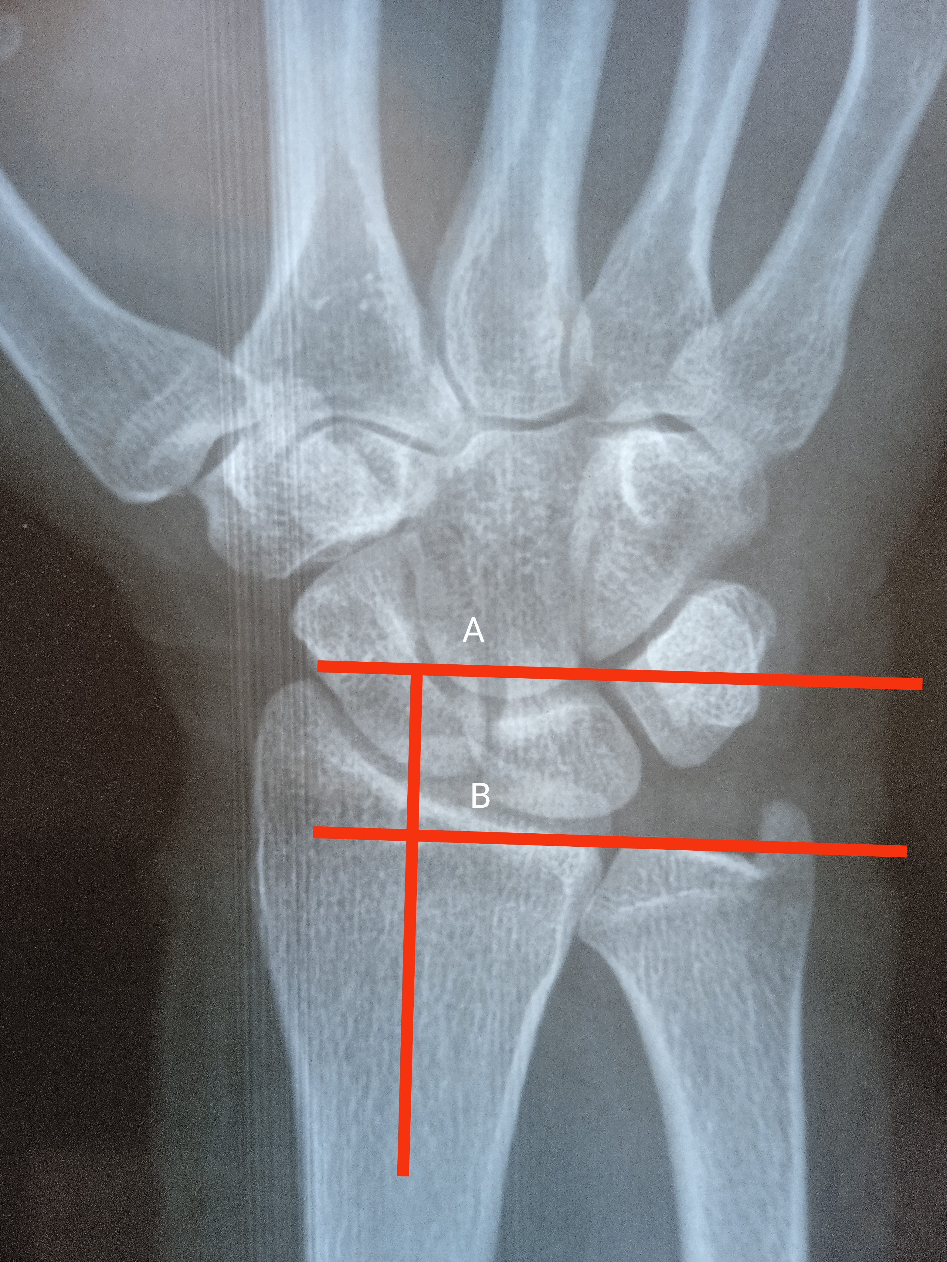 Radial Height:
Both lines are drawn perpendicular to long axis of distal radius
